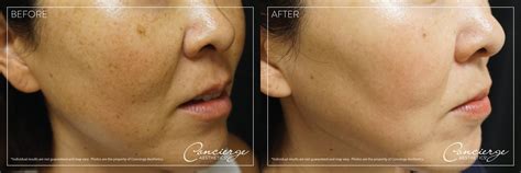 Comprar Does Ipl Hurt More Than Laser Barato&nbsp;Preço